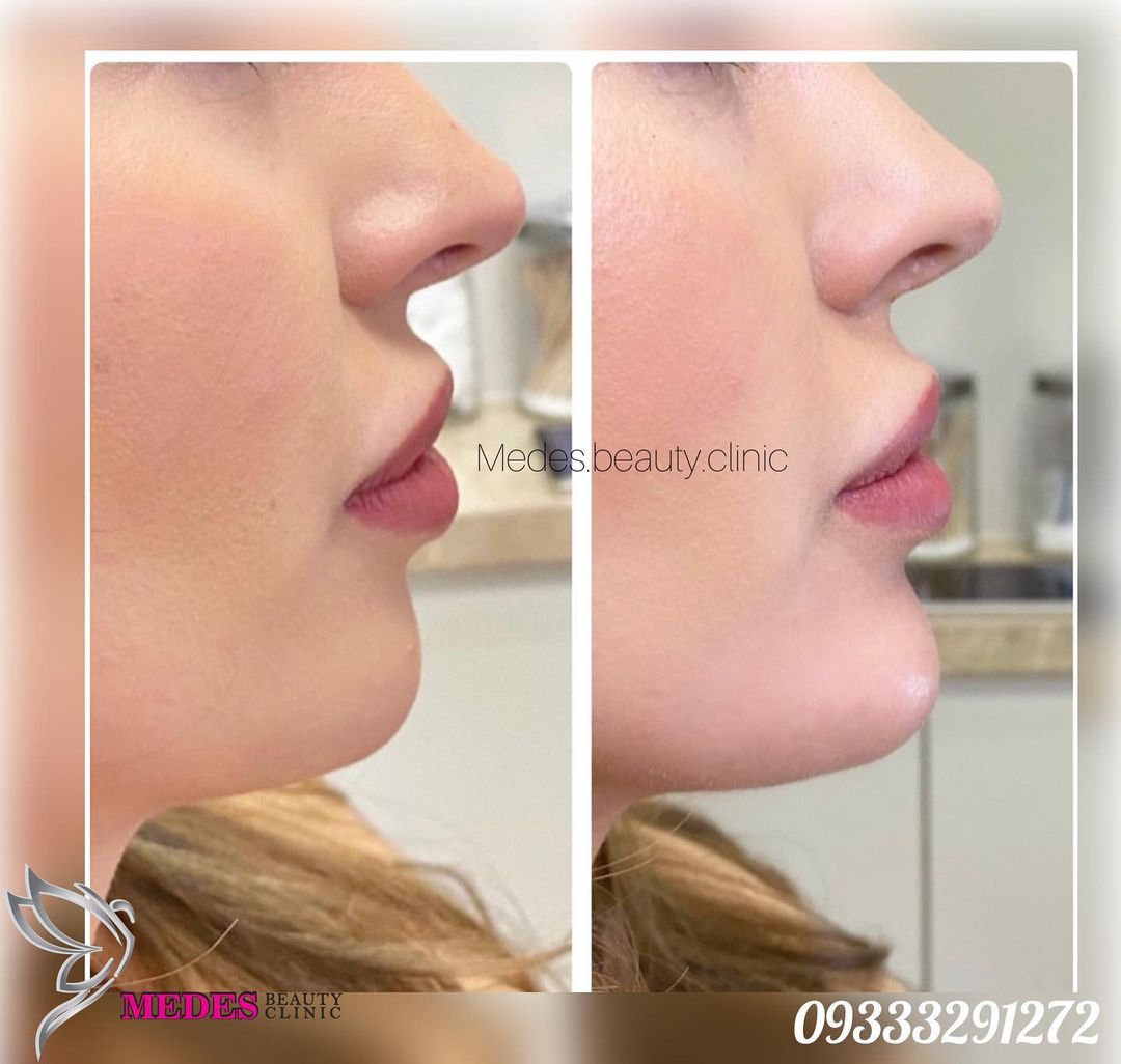 گالری زاویه سازی صورت